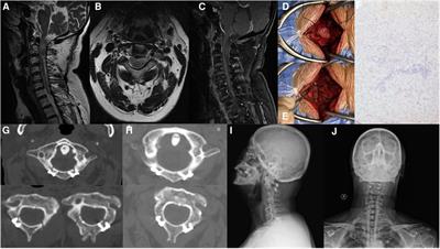 Combined replantation of the posterior arch of the atlas and bilateral axial lamina in the treatment of intradural schwannoma: a case report